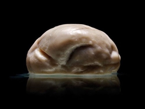 This Is A Picture Of A Human Brain That Is Entirely Smooth – Free Of The Ridges And Folds So Characteristic