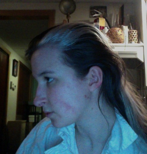 I have a white stripe now! I still need to get a haircut and dye the rest black.As it is now my hair