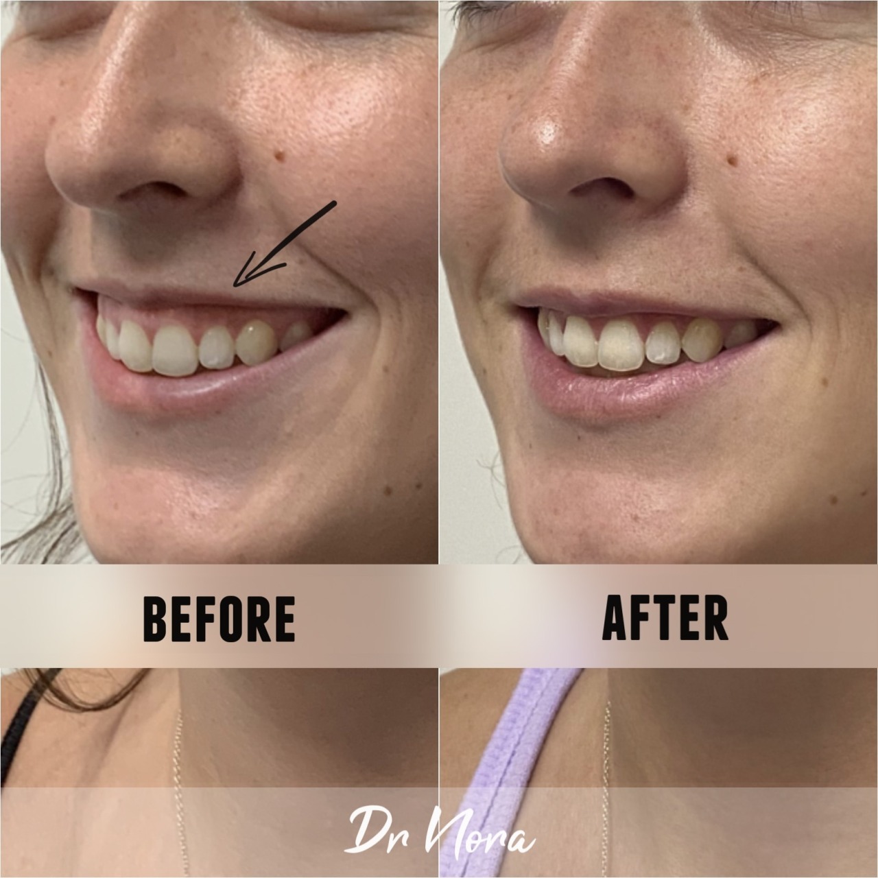Anti-wrinkle treatment of a gummy smile 😃Anti-wrinkle therapy can be used to reduce the appearance of a gummy smile. Treatment time is 15 minutes, optimal results are seen at 2 weeks and lasts up to 3-5 months.
If you have any questions or would like...