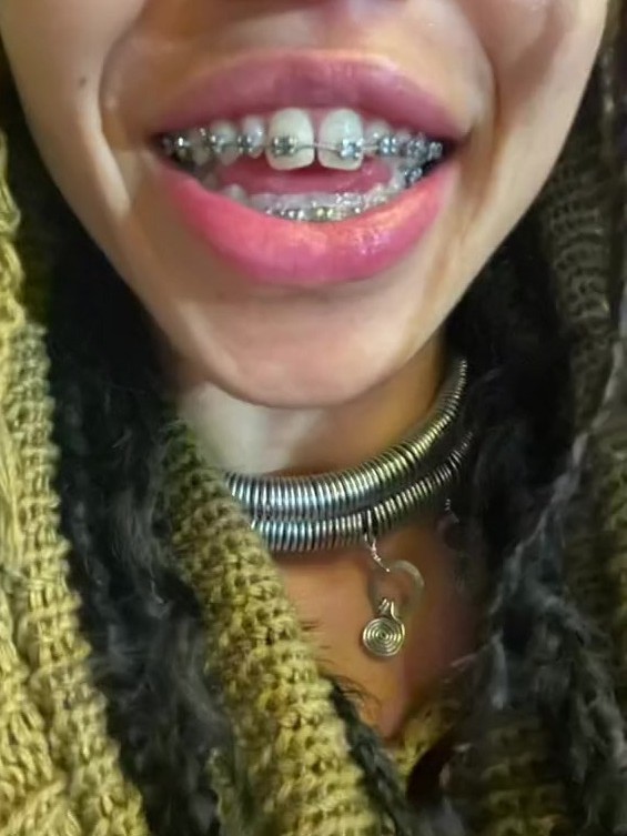 FKA twigs Makes a Case for Adult Braces — See the Photos