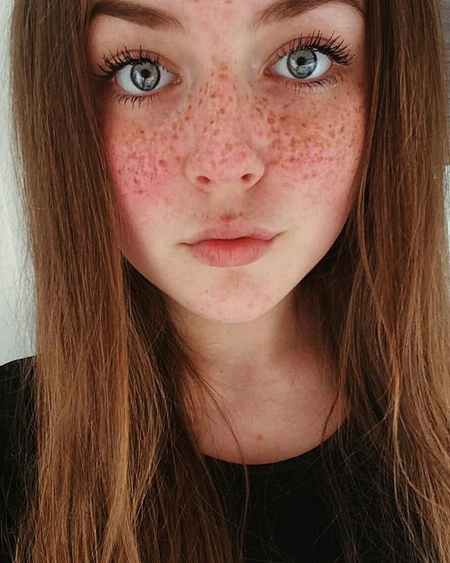 Teen Freckles