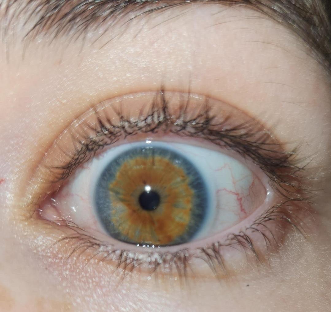 Central heterochromia on tumblr