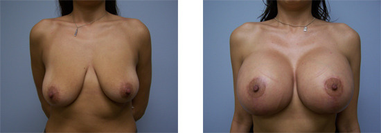 boobgrowth:  From saggy to full and round! The magic of breast enhancement surgery