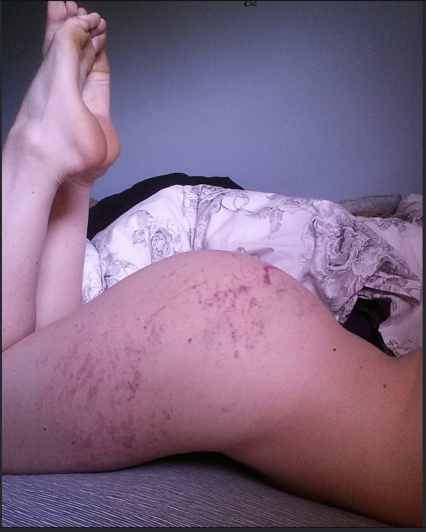 pumpkinspicedslut:  These bruuuuises make for better conversation  