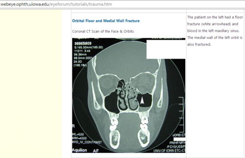 Darren Wilson's "blowout fracture"