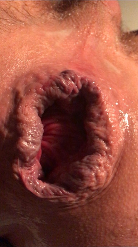 anusgigantus:  Last night’s anal assault. 