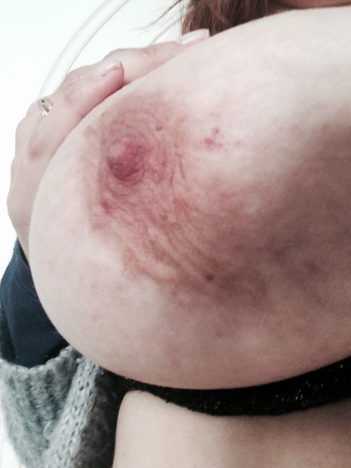 mylifeonfire36: Today My boob was hurted at work.. I think you dont see much yet but believe me I ha