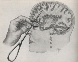 sixpenceee:  This is how a lobotomy was performed in the early 1900’s. In case you didn’t already know, a lobotomy is when doctors severed the frontal cortex from the rest of the brain. They believed they could calm a person’s emotions &amp; stabilize