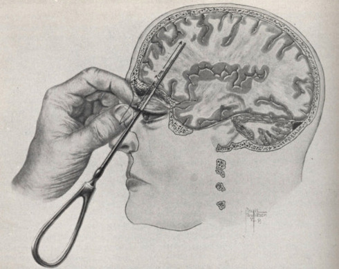 sixpenceee: This is how a lobotomy was performed in the early 1900’s. In case you didn’t already know, a lobotomy is when doctors severed the frontal cortex from the rest of the brain. They believed they could calm a person’s emotions & stabilize