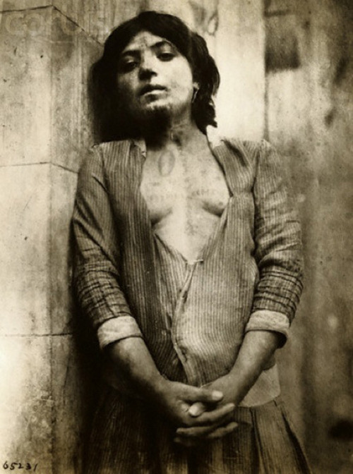 Armenian girl with identification scaring on chest and face, 1919.Credit: Underwood & Underwood/