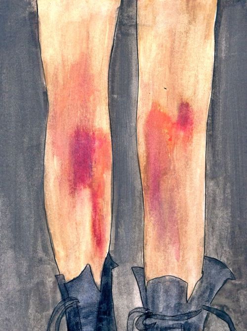 bruises