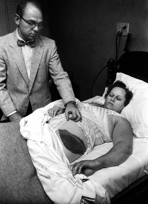 1954: the giant bruise just above the hip of Ann Hodges, pictured, is the result of the only confirm