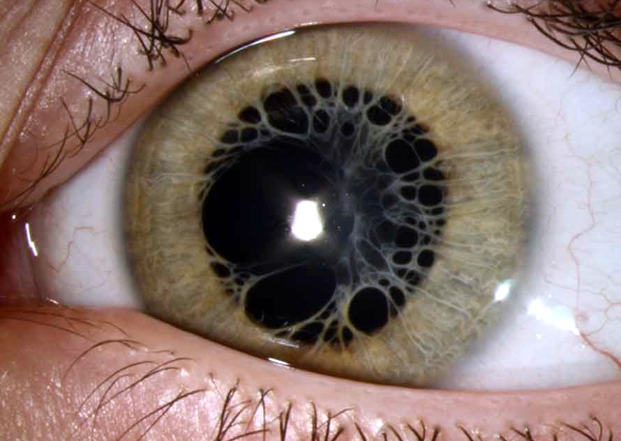 sixpenceee:  Persistent pupillary membranes are strands of tissue in the eye. They