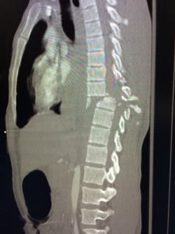 nurseeyeroll:  myradfindings:  easily the worst thoracic spine fracture I have ever seen associated with extensive paraspinal hematoma.  Good God. 