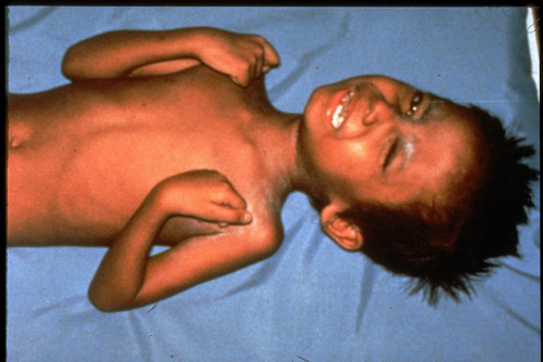 physiologicdeadspace: Tetanus is a disease caused by an infection of the bacteria ‘Clostridium