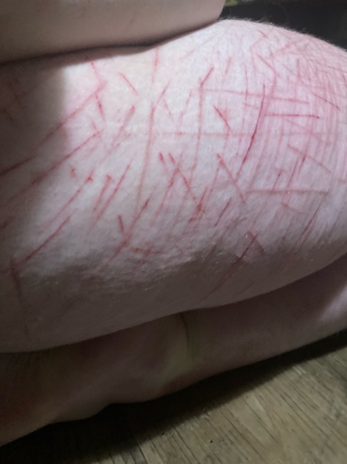 TW Self Harm!
