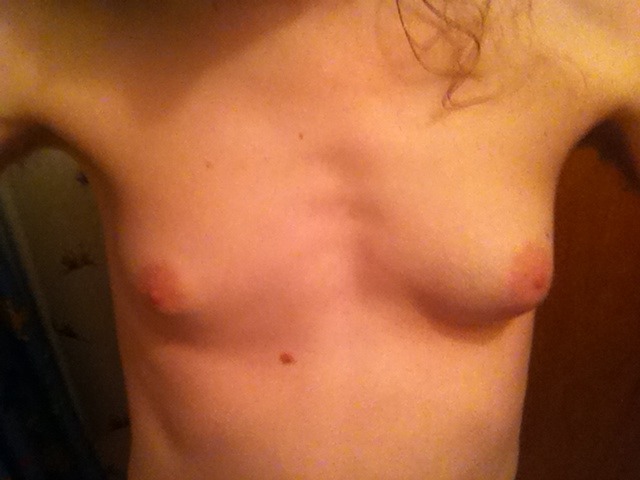 sirenfeme:  girlcock-eyed:  Post-shower boobs. Nearly 3 years HRT, 2mg E/200 Spiro.
