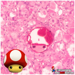 ihearthisto:  🕹️ 🍄 Power-Up! 🍄   🕹️   A much needed mid-week power-up. Lets-a-go!   i♡histo This super mushroom represents vascular invasion within a rare tumor (Alveolar Soft Part Sarcoma) in the thigh of a 22 year old female. You