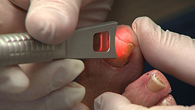 Sex Laser Treatment A New Way To Treat Nail Fungus pictures