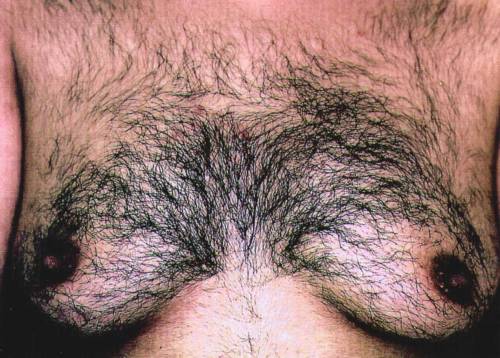 hirsutism