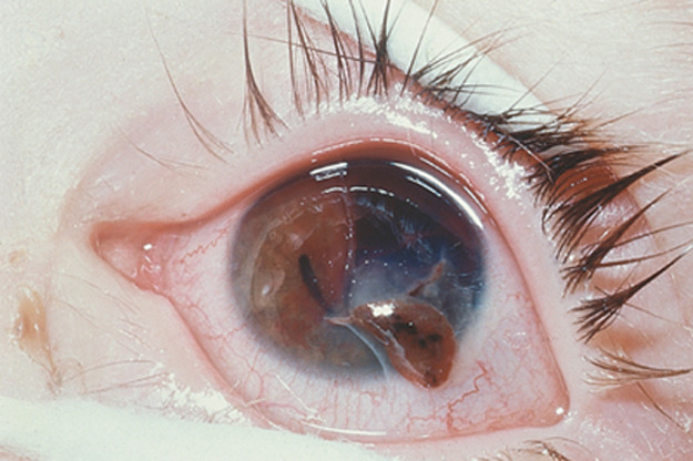 bavians:  lessons-in—gore:  Ruptured ocular globe.