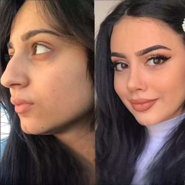 Dubai's Rhinoplasty Revolution: Crafting the Perfect Profile – @rhinoplastydubai on Tumblr