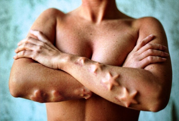 sixpenceee:  Subdermal ImplantOriginating in 1994, subdermal implant is a method