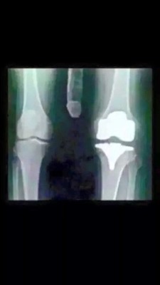 bates1976:  Just got my xrays back!!