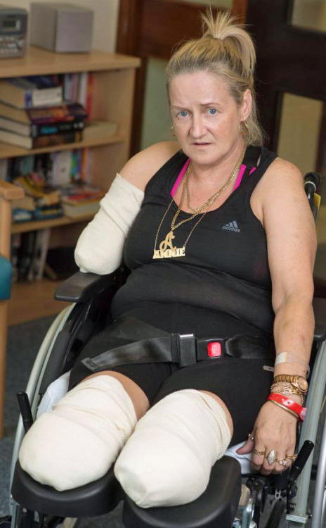 UK TV personality Annie Caddis who lost her legs below knee and arm at/above elbow to infection.