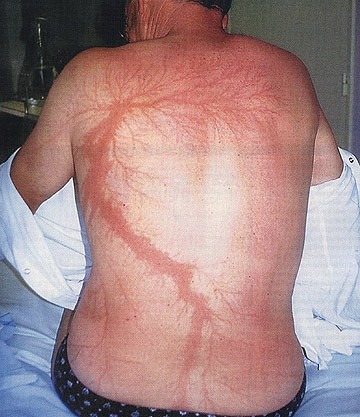 Lightning tattoos or Lichtenberg figures, which are burns as the result of being struck by lightning. Trees can also have similar patterns after being struck.