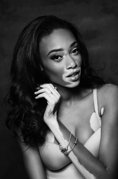 thefashionyoleauxist:Chantelle Brown-Young / Winnie Harlow.