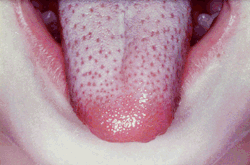 odd-titties:  Scarlet Fever (White Strawberry Tongue) 