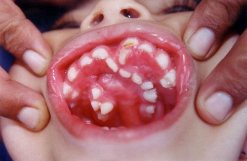 hyperdontia or supernumerary teeth