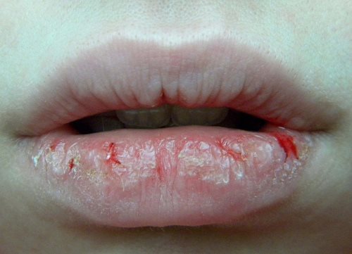 I wanna live in NM but my lips stay like this.