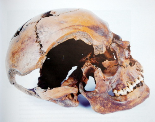 Violence in Viking Age Dublin. This human skull contains evidence of a severe sword cut to the side 