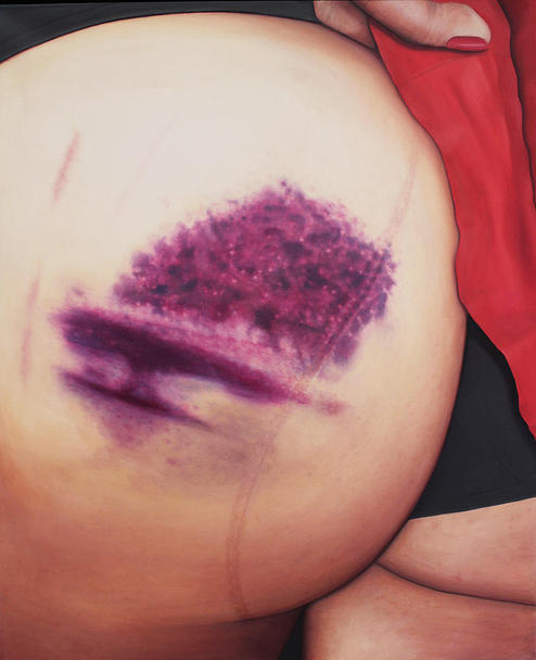 nevver:  Bruised, Rikka Hyvönen