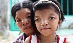 euthanizeallwhitepeople:  “Nguyen Thi Ly, 11, skips rope in her village south of Da Nang, Vietnam.  Her grandfather served in the North Vietnamese Army during the Vietnam War, and she is a third generation victim of dioxin exposure, the result of Agent