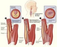 Carotid Ultrasounds http://www.pinterest.com/pin/544091198701782542/