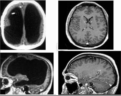 medicalwatson:  sixpenceee:  If you thought the post on twins sharing consciousness