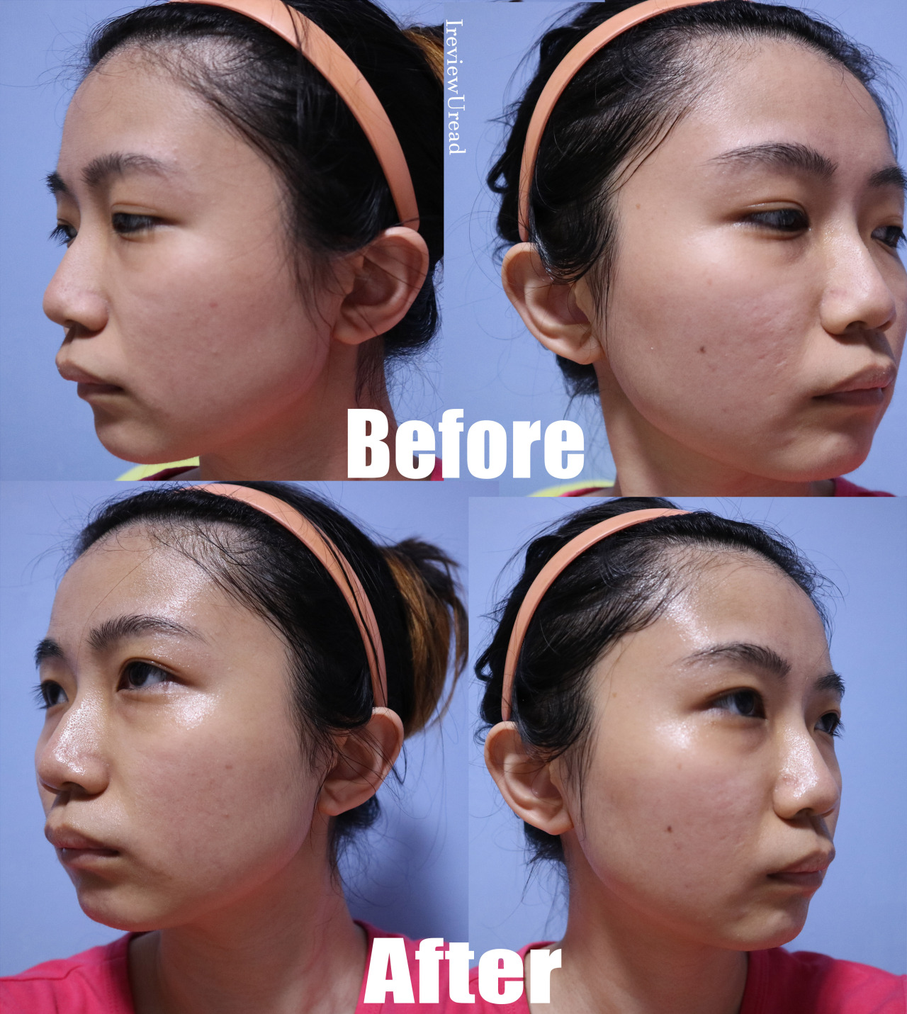 Anti-blue Light Facial Mask Review Before and After