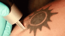 sixpenceee:  Laser Tattoo RemovalGIF made by Sixpenceee. Original video via YouTube. 