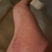 The power of snacks and ice baths. I figure a few more days and the heel will be more or less in decent shape. 