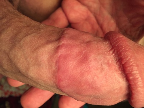 foreskin2cut: wintfun: tightlycut: 24th August 2015 - 24th February 2016. What a difference six mont