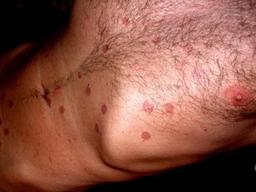 gymboas:These painful stinging burn marks are here to stay for a couple of days and the only thing that I a worried about is; what will my gymmates say when the notice this?