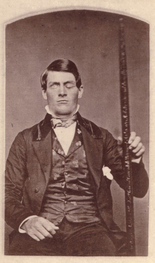 fuckyeahhistorycrushes:  This is Phineas Gage, a railroad worker who survived an