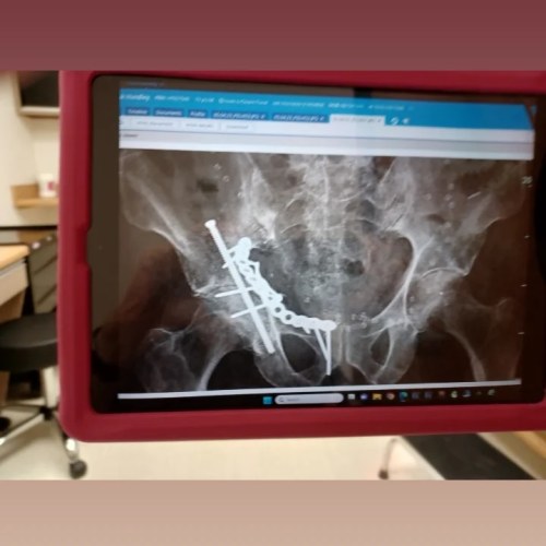 Dr. Says On My Way To Being The 6 Million Dollar Man Got Arthritis In Hip Will Need A Total Hip In The