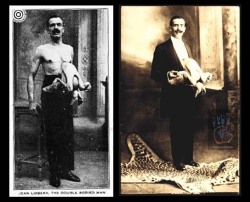 sixpenceee:  Jean Libbera (1884 - 1936), was also known as “The Double-Bodied Man”. He had his brother, Jacques Libbera, connected to his from his chest-stomach area. He was born in Rome. The parasitic twin was alive and could move as well. An X-ray