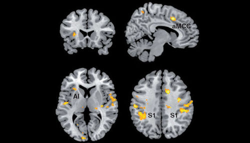 neurosciencestuff:(Image caption: MRI scans of the brain: stress-induced brain activation during vie