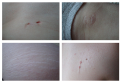  A scar someone gave me. A scar I gave myself. A scar I got naturally. A scar I got accidentally. 