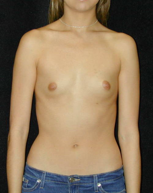 sexyflatchested: Breast augmentation pre-op photos.  Too bad they ruined some nice tiny tits wi